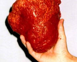 Enlarged Heart